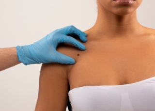 Dermatologist image - Chest and shoulder area and a hand in blue gloves.